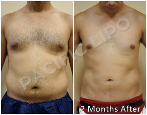 Military Liposculpture by Pacific Lipo's Director of Surgery, Rod Davis PA
